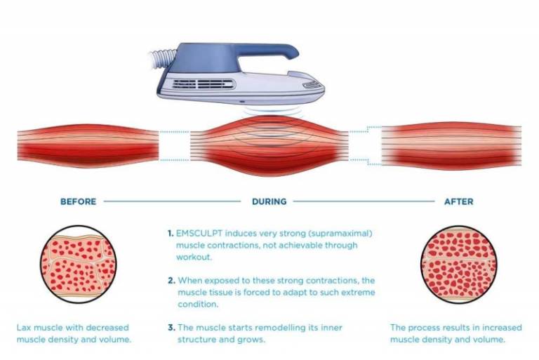 EMSCULPT