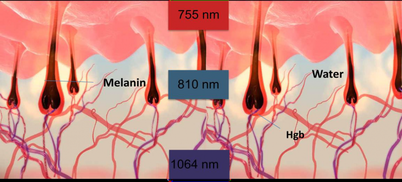 SOPRANO ICE PLATINUM Νέα γενιά laser